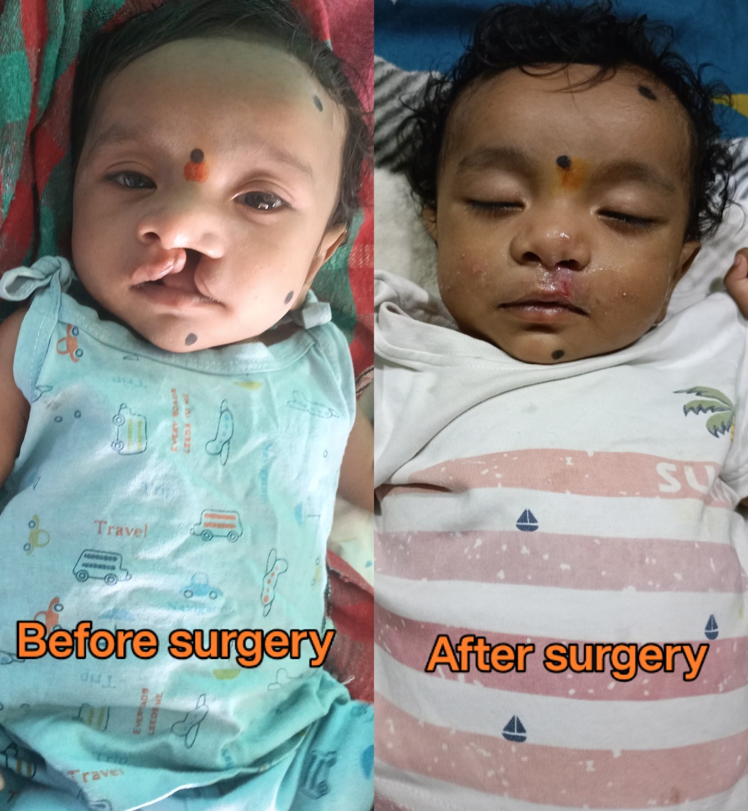 चिरायु टीम की तत्परता से तीन माह के मासूम को मिली नई मुस्कान     जन्मजात कटे होंठ का निःशुल्क सफल ऑपरेशन, अब सामान्य रूप से कर रहा स्तनपान
